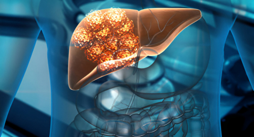 Meccanismi Metabolici ed Epigenetici nell'Epatoblastoma: Nuove Strategie Terapeutiche